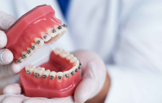 Brackets, carillas o alineadores: ¿Cuál es la mejor opción para corregir dientes separados?