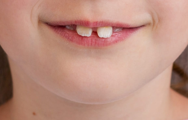 ¿Es posible corregir dientes separados en casa? Mitos y realidades