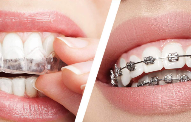 Aparato invisible precio vs brackets tradicionales: ¿Vale la pena la inversión?