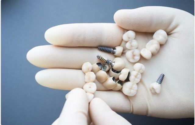 Beneficios y Desventajas de los Implantes Dentales en Las Palmas de Gran Canaria