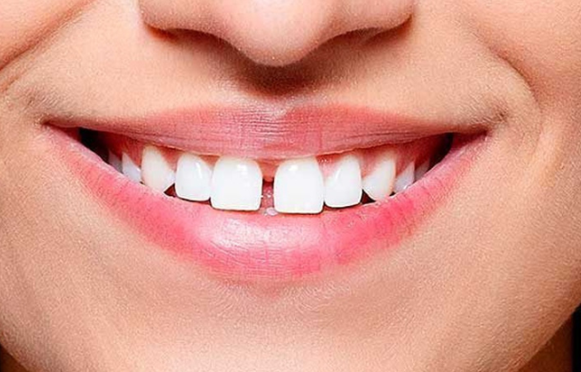 Cómo corregir dientes separados: Métodos efectivos y recomendaciones