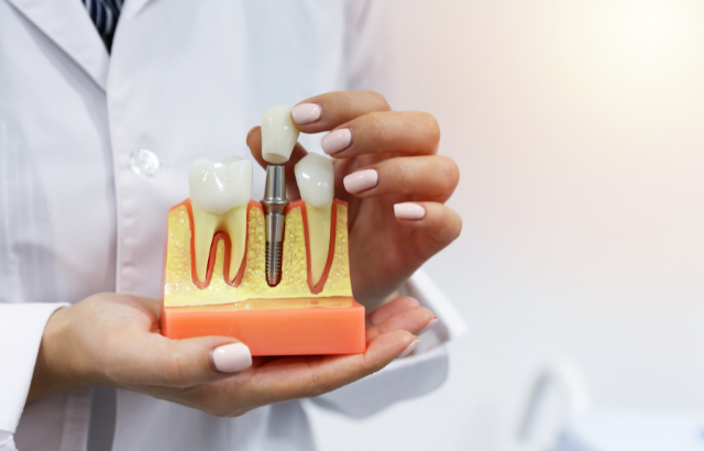 ¿Los implantes dentales son para toda la vida? Durabilidad real