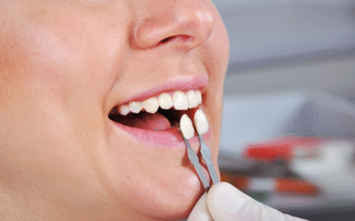¿Qué son las carillas First Fit y cómo revolucionan la estética dental?