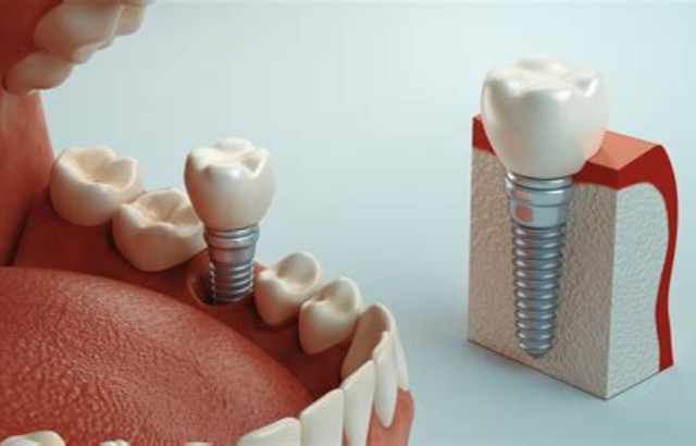 Ventajas y Desventajas de los Implantes Dentales en Las Palmas: ¿Realmente Valen la Pena?