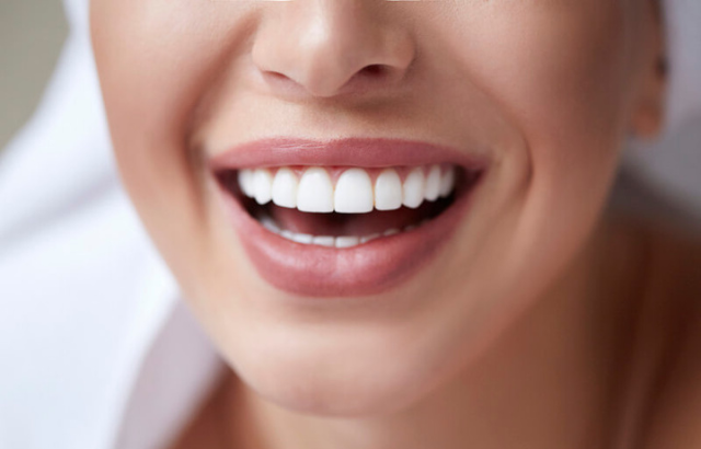 Sonrisa de Celebridad Canaria: ¿Las Carillas Dentales Son para Todo el Mundo?