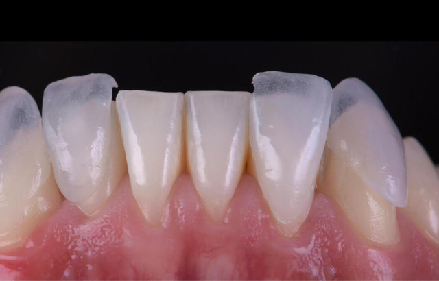Carillas dentales