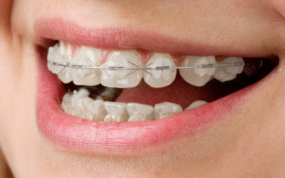 Brackets Metálicos vs. Invisalign: ¿Cuál es la Mejor Ortodoncia para ti?