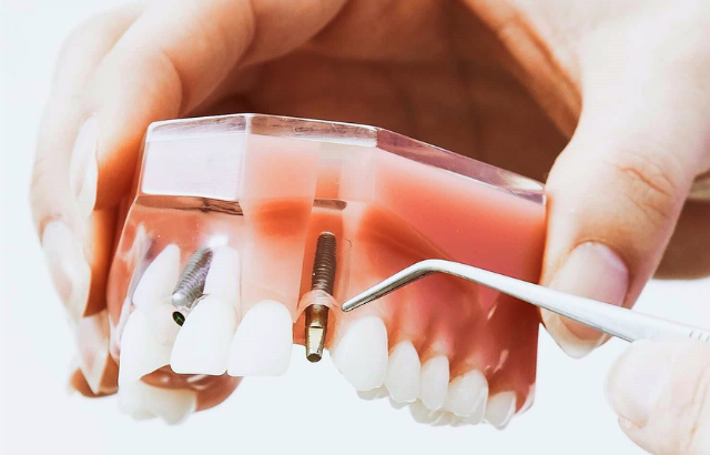 1 Implantes Dentales