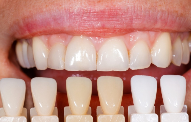 ¿Cuánto Duran las Carillas Dentales y Cómo Prolongar su Vida Útil? Palmas de Gran Canaria