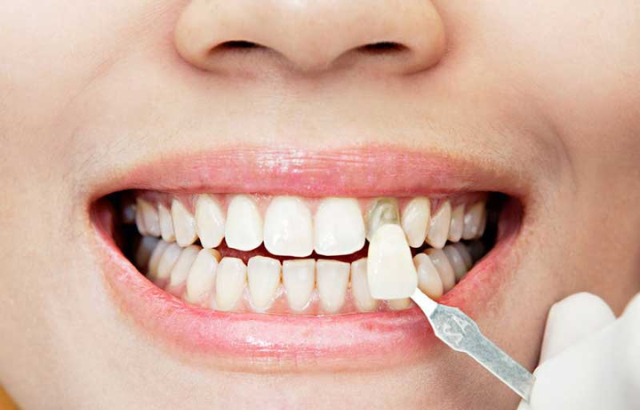 El Proceso de Colocación de Carillas Dentales en Canarias: ¿Duele o Requiere Tiempo de Recuperación?