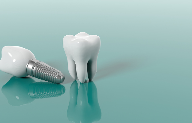 Implantes Dentales en Gran Canaria: ¿Qué Son y Cuándo Son Necesarios?