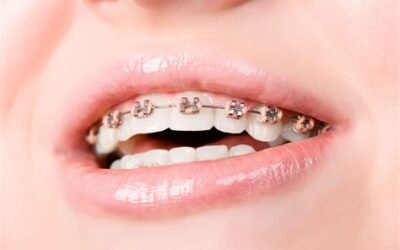 Tecnología en Ortodoncia: ¿Cómo Han Mejorado los Brackets y Alineadores en los Últimos Años en Islas Canarias?