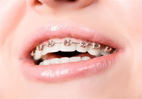 Tecnología en Ortodoncia: ¿Cómo Han Mejorado los Brackets y Alineadores en los Últimos Años en Islas Canarias?