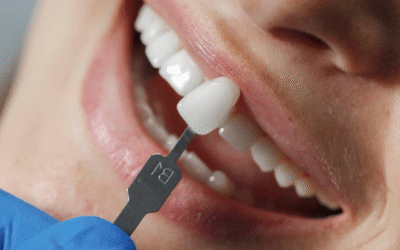 Carillas Dentales en Canarias: ¿Qué Son y Cómo Transforman Tu Sonrisa?