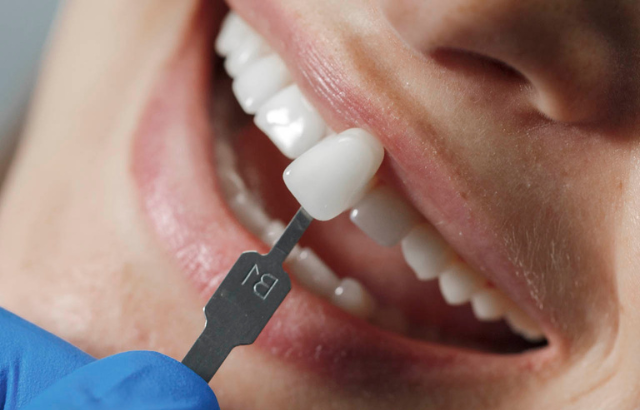 Carillas Dentales en Canarias: ¿Qué Son y Cómo Transforman Tu Sonrisa?