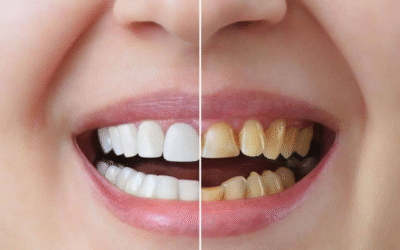 Carillas de Porcelana vs. Carillas de Composite: ¿Cuál es la Mejor Opción en Canarias?