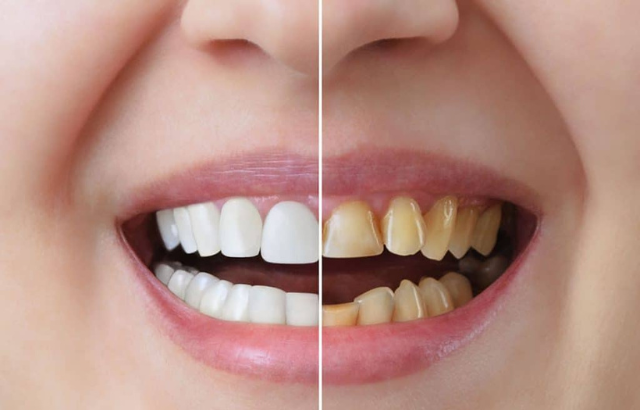 Carillas de Porcelana vs. Carillas de Composite: ¿Cuál es la Mejor Opción en Canarias?