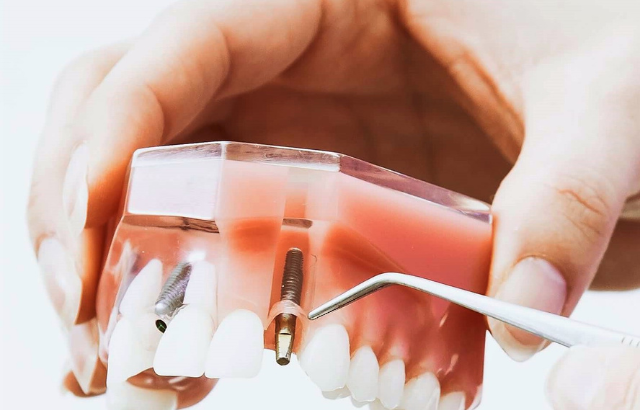 Cuidados ideales para los Implantes Dentales