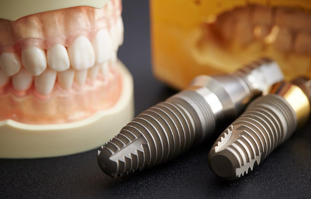 1 Implantes dentales