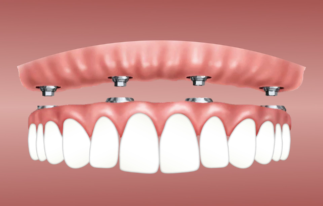 1 Implantes dentales