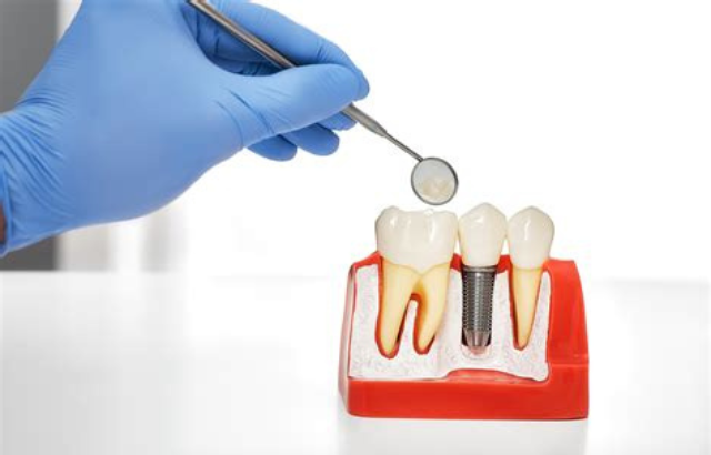 ¿Es recomendable ahorrar cuando se trata de Implantes Dentales? Descubre precios y posibles descuentos en España