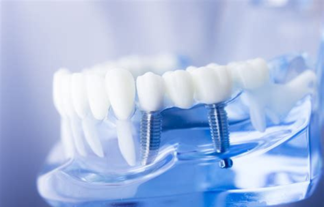 Resuelve tus Dudas Sobre Implantes Dentales en España con una Consulta Profesional