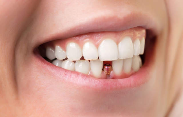 Cómo funcionan los implantes dentales y qué esperar durante el proceso