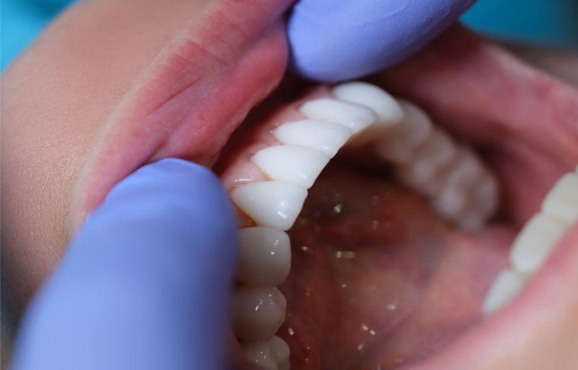 Por qué las ‘carillas inyectadas’ son la tendencia más polémica en la odontología estética española