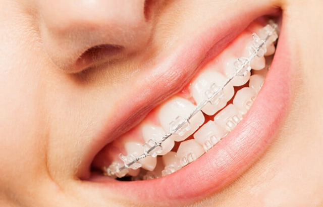 Ortodoncia invisible, carillas o brackets: ¿Cuál es la mejor opción para corregir dientes separados?