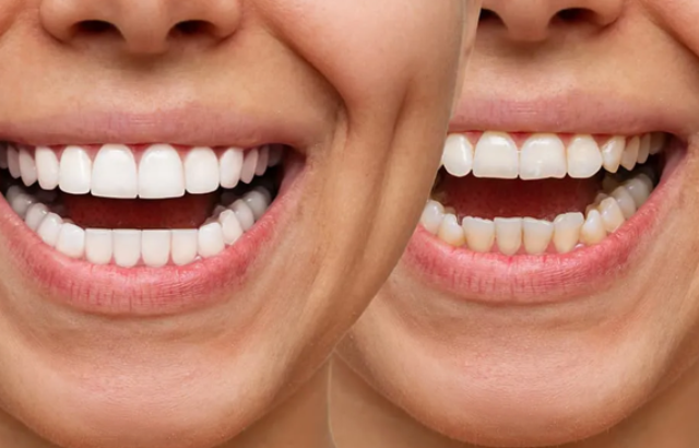 Carillas Dentales en España: ¿cómo evitar presupuestos engañosos?