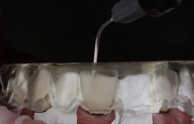 Comparativa en profundidad: carillas inyectadas vs otros tratamientos odontológicos