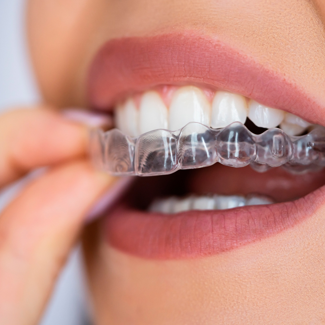 Invisalign